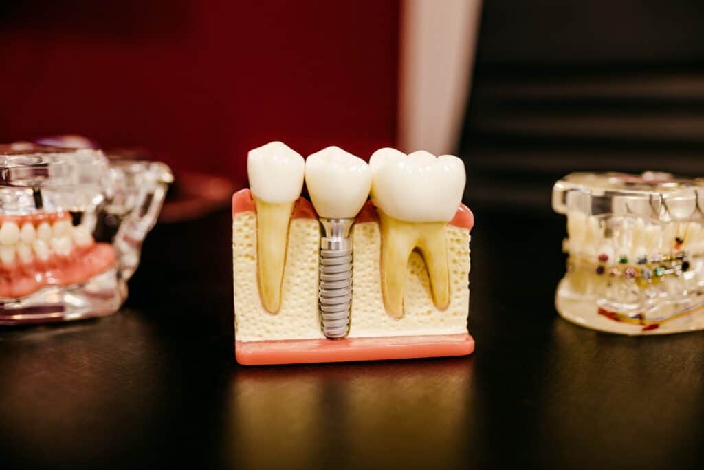 Best Dental Implant Brands